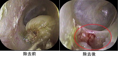 外耳道真珠腫　前後